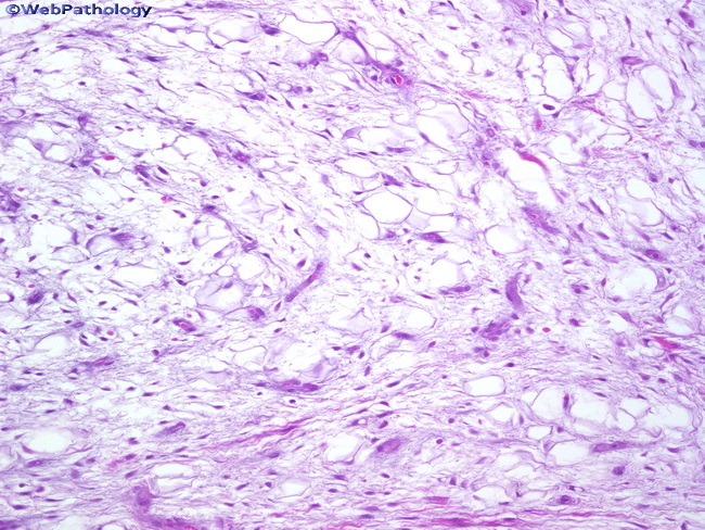 Soft Tissue_Lipomatous_Lipoblastoma4A.jpg